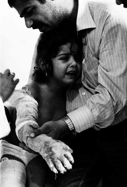 イスラエルの空爆で火傷したパレスチナの女の子 1982年：広河隆一写真展「戦場の子どもたち」原爆の図丸木美術館